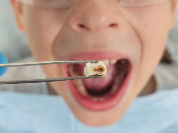 Best Emergency Wisdom Teeth Removal in Princeton, TX